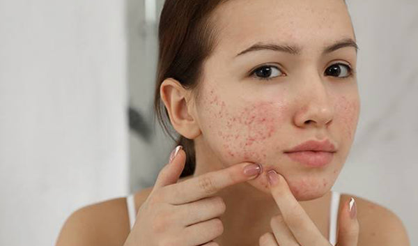 Skincare For Acne Prone Skin