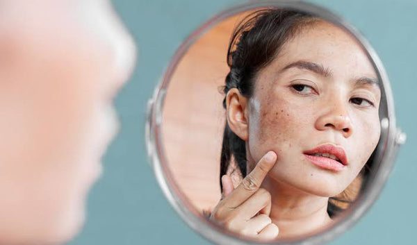 How to reduce hyperpigmentation? 